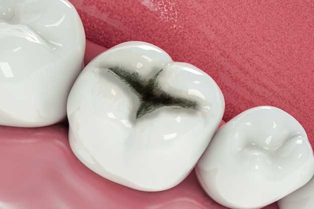 Почему в лунке после удаления зуба мудрости остается белое вещество?